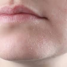Peau seche